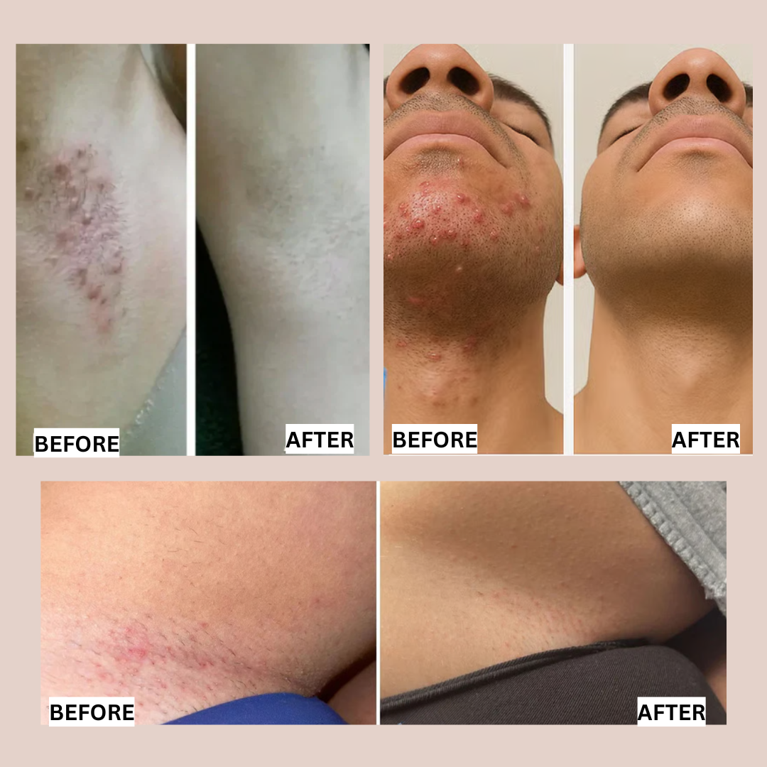 Smoothing Ingrown Hair Serum